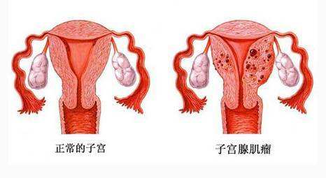 子宮肌瘤是如何導致流產和不孕的