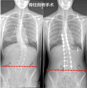 判斷有脊柱側彎的方法