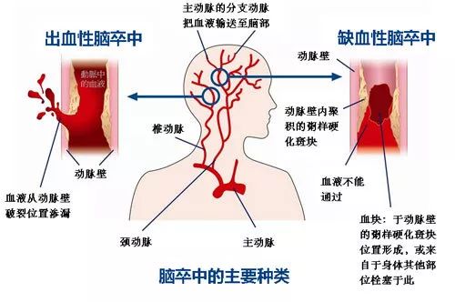 世界卒中日 | 識別卒中早一秒，挽救大腦恢復好