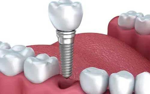種植牙為何如此受歡迎？這些知識要知曉！